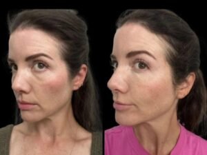 Latest Innovations in Dark Circles Treatment in Dubai for Men and Women