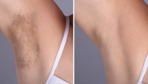 Laser Hair Removal Treatment in Dubai: Quick, Painless, and Effective