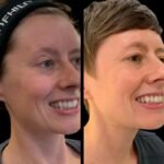 Spark the Radiant Transformation via Profhilo and Best Doctors in dubai