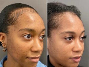 A Complete Chemical Peel Journey with the Best Plastic Surgeon in Dubai