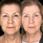 Revamp Your Look via Profhilo at Best Aesthetic Clinics in dubai