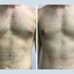 Gynecomastia in Dubai: Expert Opinions from Leading Surgeons