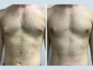Gynecomastia in Dubai: Expert Opinions from Leading Surgeons