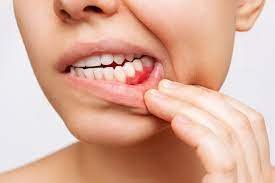 Amoxicillin Dosage for Dental Infections Explained