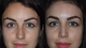 Before and After Perfection with the Best Rhinoplasty Surgeon in Dubai