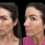 Why Patients Trust the Best Doctors in Dubai for Dark Circles Treatment Solutions