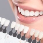 Everything You Should Know Before Getting Veneers in Islamabad