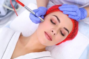 Acne Scars Treatment in London: Transform Your Skin with Modern Techniques