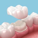 Dental Crowns and Bridges Dubai | Restore Your Teeth