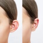 Best Ear Surgery in Islamabad
