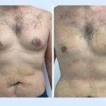 Advanced Surgical Devices Used for the Gynecomastia in Dubai Surgery