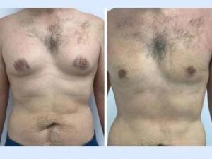 Advanced Surgical Devices Used for the Gynecomastia in Dubai Surgery