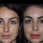 Restoring Comfort with Care: Best Doctors in Dubai for Septoplasty