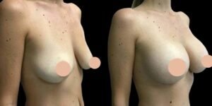 The Art and Precision of the Best Breast Augmentation Surgeon in Dubai