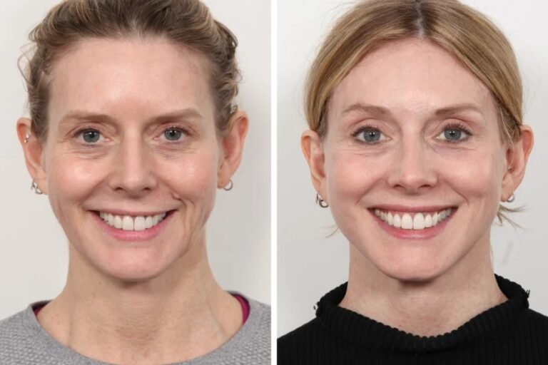 Thread Lift Patient Journey at the Best Aesthetic Clinics in Dubai