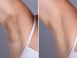 Best Plastic Surgeons in Dubai Recommend Laser Hair Removal for Permanent Results