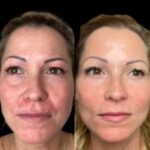 Skin Vitality via the Profhilo Treatment in Dubai