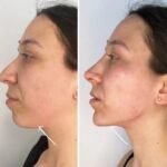 Combining Skincare and Endolift Treatment in Dubai for Long-Lasting Results