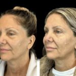 How the Best Doctors in Dubai Achieve Natural, Youthful Botox Results