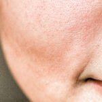 Best Large Pores Treatment Techniques in Islamabad