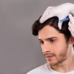 Is PRP Hair Treatment Risky in Dubai?