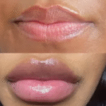 Shoulder Problems From Weight Lifting & Can I Work Out After Lip Filler? A Complete Guide