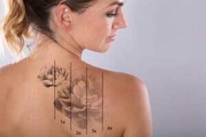 Tattoo Removal in Dubai: Results After 5 Sessions