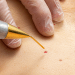 What Makes Modern Warts Removal Treatments So Fast and Effective?: