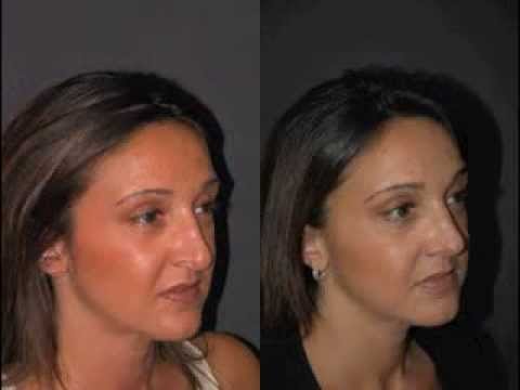 كيف تضمن الحصول على أفضل نتائج تجميل الأنف قبل وبعد؟