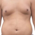 Gynecomastia Surgery Success Rate: What Men Need to Know Before Treatment
