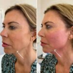 How Best Aesthetic Clinic in Dubai Combines Endolift with Fillers for Maximum Lift
