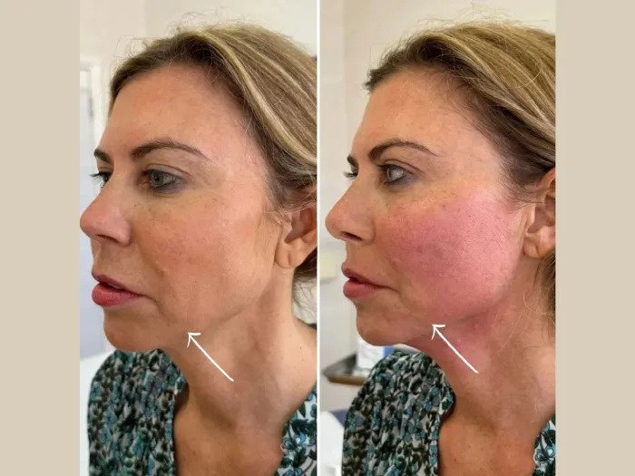 How Best Aesthetic Clinic in Dubai Combines Endolift with Fillers for Maximum Lift