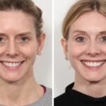 Thread Lift Treatment in Dubai for Firming Loose Skin