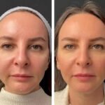 Why the Best Doctors in Dubai Recommend Mesotherapy for Natural Beauty Enhancement