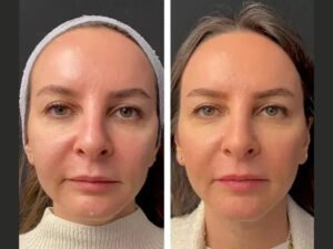 Why the Best Doctors in Dubai Recommend Mesotherapy for Natural Beauty Enhancement