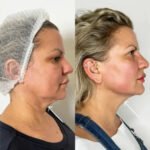 How the Best Aesthetic Clinic in Dubai Combines Endolift with Fillers for Maximum Lift