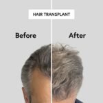 Islamabad’s Trusted Solution for Permanent Hair Restoration
