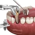 Dental Implants Specialist in Pune
