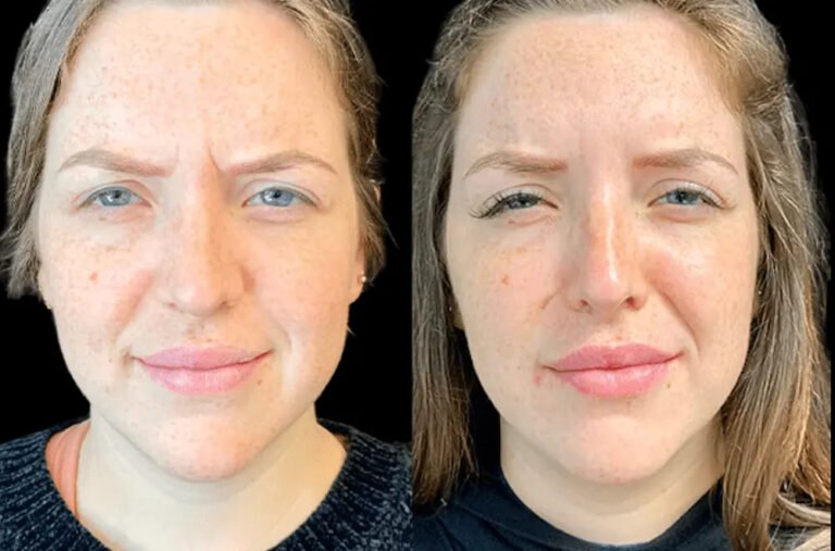 The Growing Popularity of Botox Treatments in Dubai