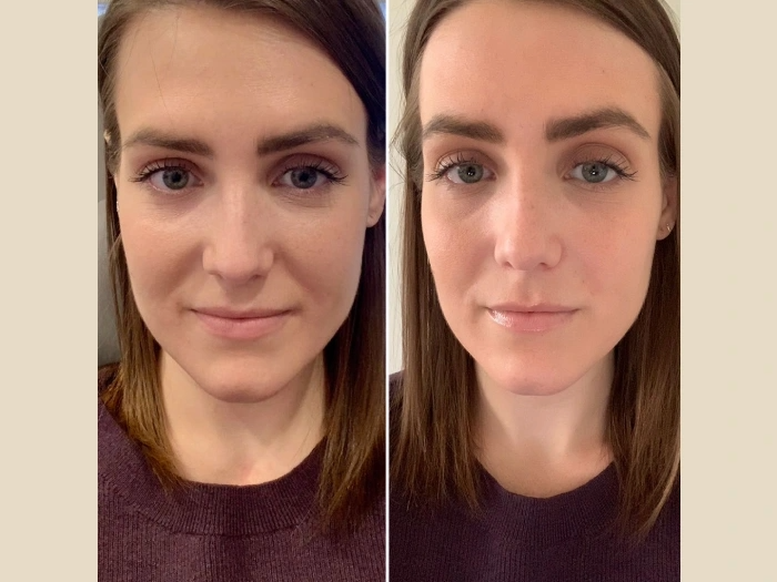 Best Doctors in Dubai for Celebrity PRP Treatment