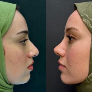 Achieve a Harmonious Look with Rhinoplasty in Islamabad