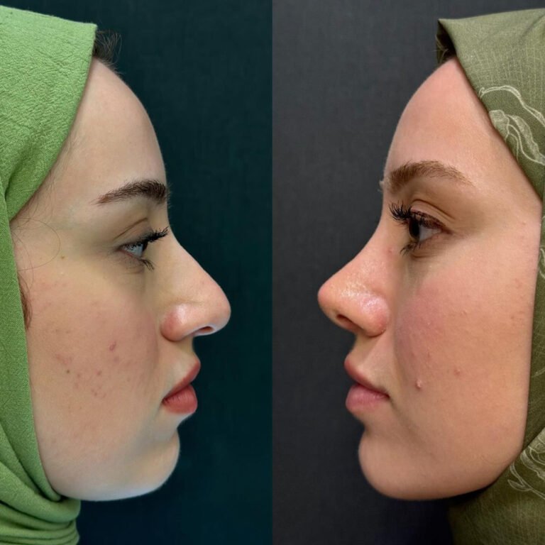 Achieve a Harmonious Look with Rhinoplasty in Islamabad