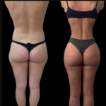 Everything You Need to Know About J-Plasma from the Best Doctors in Dubai