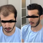 How to Apply a Hair Patch Like a Pro