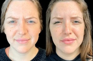 Best Doctors in Dubai for Botox: Common Mistakes to Avoid