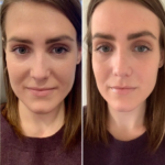 PRP Treatment in Dubai for Hair Thickening