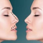 تجميل الأنف غير الجراحي في دبي: هل الفيلر هو الحل؟