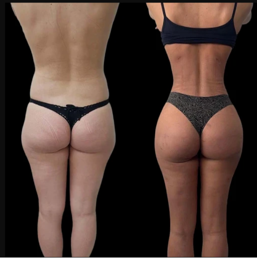 Best Plastic Surgeon in Dubai Reveals J-Plasma Recovery Tips