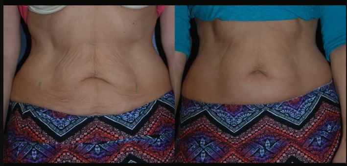 Skin Tightening Excellence with Best Doctors in Dubai