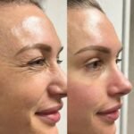 Botox in Islamabad – Botox for Under-Eye Wrinkles: Treatments and Benefits